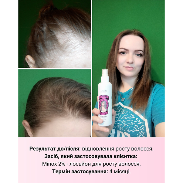 Лосьон для роста волос (Минокс) MinoX 2 Lotion-Spray для женщин